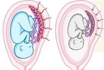 الكشف المبكر عن تأخر نمو الجنين داخل الرحم يساهم باستبعاد حدوث المخاطر